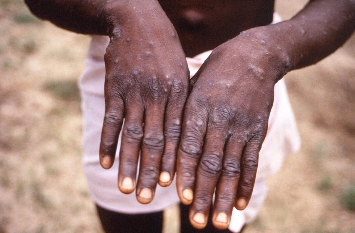 SL commence testing for Monkeypox