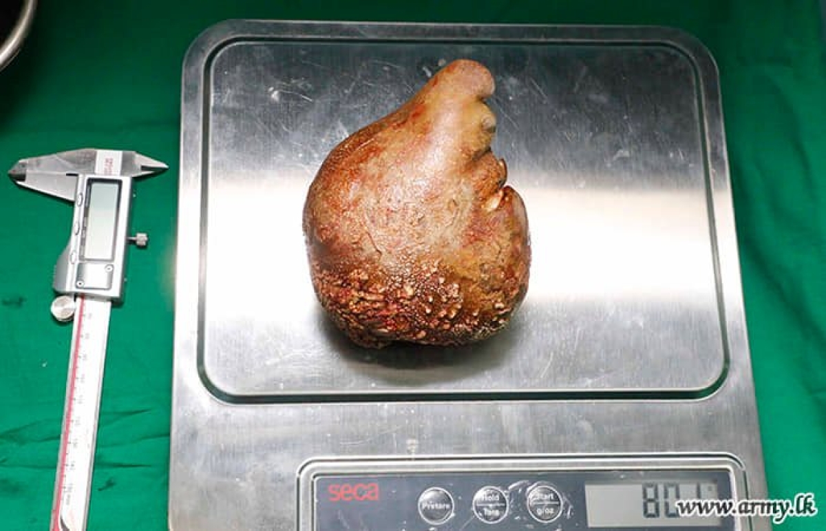 Colombo Army Hospital Enters Guinness World Records for World&#039;s Largest Kidney Stone Removal